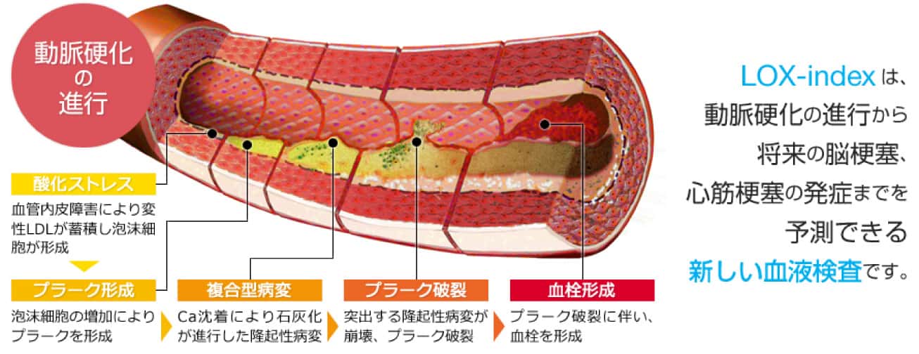 動脈硬化の進行